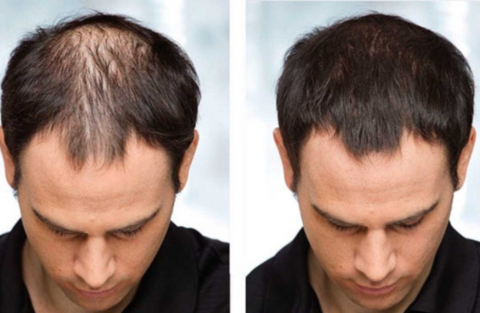 latest research male pattern baldness
