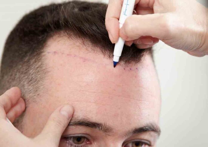 Which Hair Transplant Clinic is the Best - Asli Tarcan Clinic