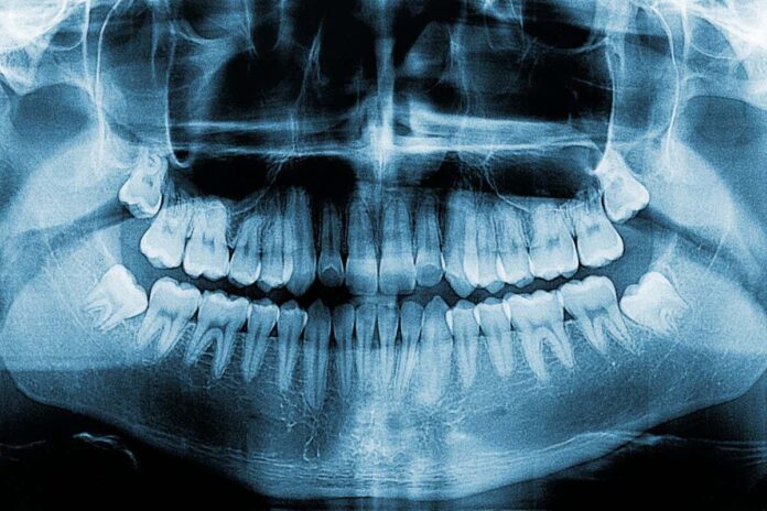 dental X-rays
